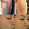 Picoway Laser Tattoo Removal Beauty Equipment Vertical Pigment Treatment