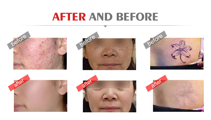 Picosecond laser tattoo removal machine cost BM23 Picosecond laser tattoo removal machine cost BM23